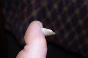 Nagelpilzsymptome