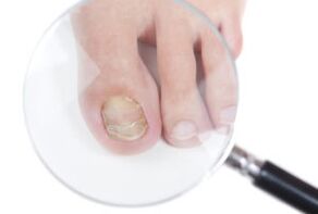 Ursachen für Nagelpilz