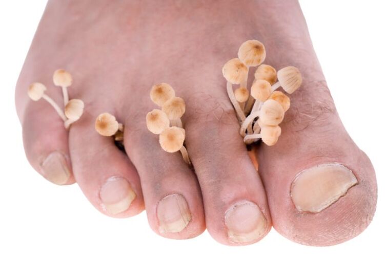 Beinpilzsymptome